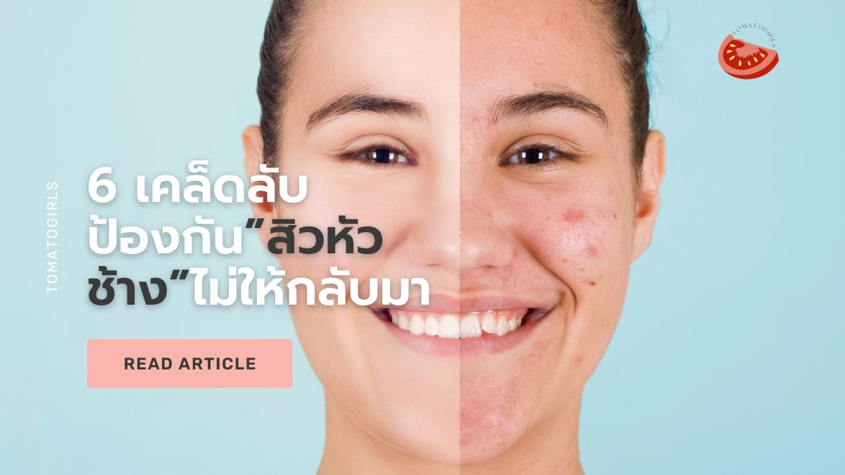 6 วิธีป้องกันสิวหัวช้างไม่ให้กลับมาอีก